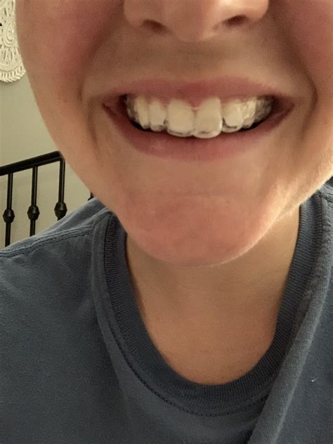 Not Wearing Retainer After Braces How Long Will I Need To Wear