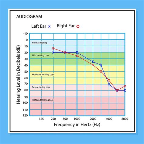 Audiogram Types and examples 的图像结果