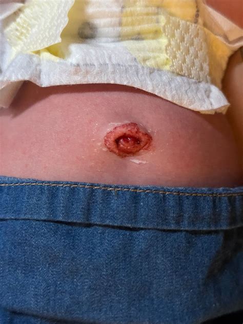 Belly button bleeding!? | BabyCenter