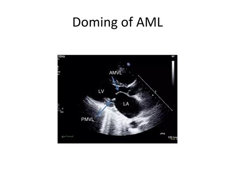 Mitral stenosis Echocardiography | PPT