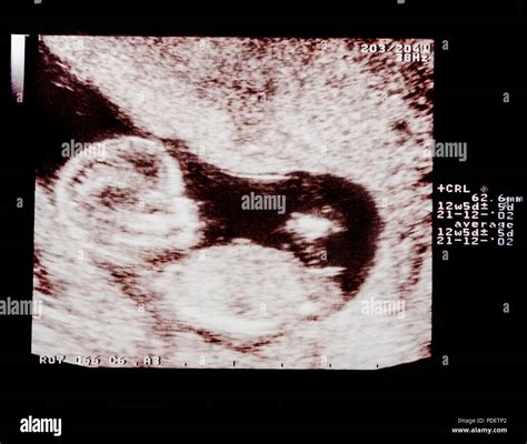 What's The Earliest You Can See Baby On Ultrasound at Jett Delamothe blog