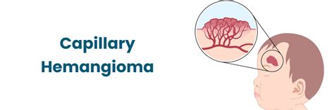 What is Capillary Hemangioma?