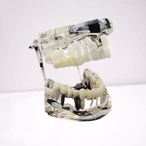 pyrax Dental implants, Crown and bridge, Implant-supported bridge ...