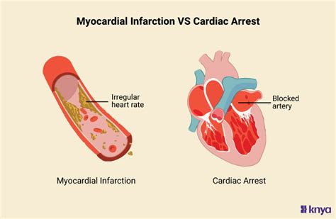 Difference Between Myocardial Infarction and Cardiac Arrest – Knya