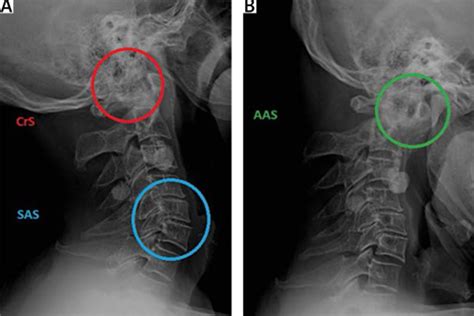 Arthritis In The Neck