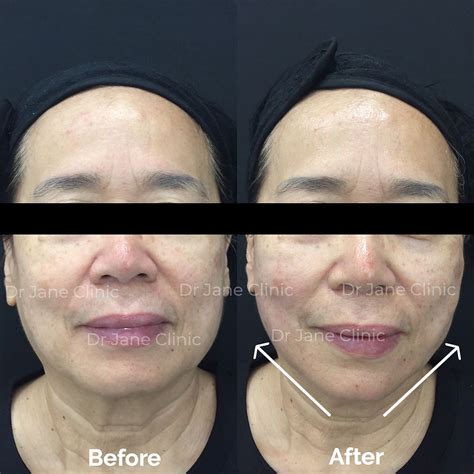 Image result for V-shape Face Exercise