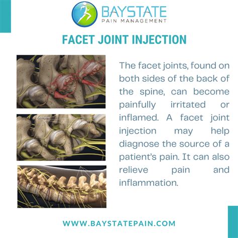 Facet Joint Injections | Best Pain Clinic 02379