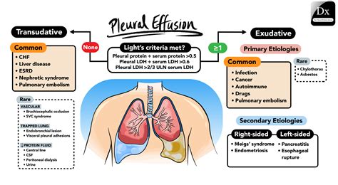 How To Identify Pleural Effusion On X Ray at William Woodard blog