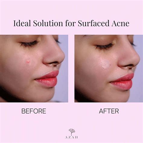 Buy AZAH ACNE PATCH|TRANSPARENT HYDROCOLLOID PATCHES QUICK ACNE|60 ...
