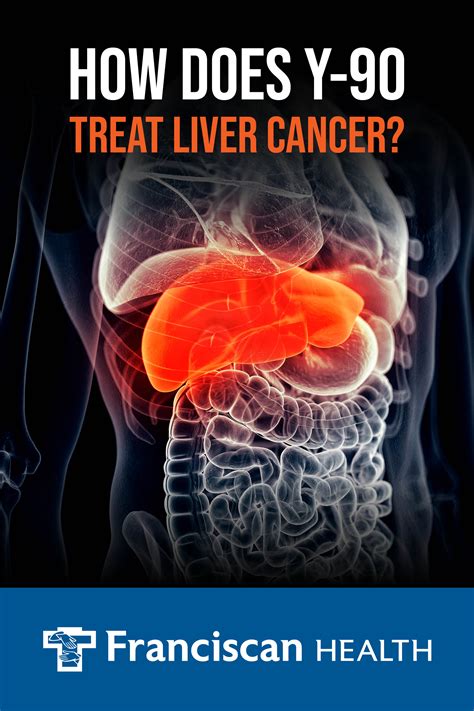 How Does Y-90 Treat Liver Cancer? | Franciscan Health