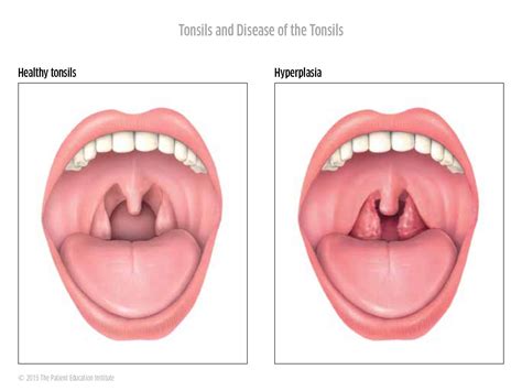 Tonsils - HNO Sarnen