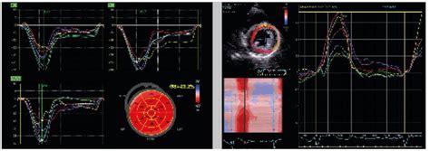 Speckle-Tracking-Echokardiografie - Kardiologie & Gefäßmedizin ...
