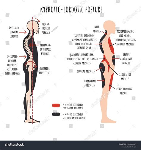 Posture Disorders Infographic Kyphotic Lordotic Posture Stock Vector ...