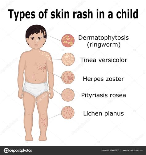 Pityriasis Rosea Linked To Cancer | ppgbbe.intranet.biologia.ufrj.br