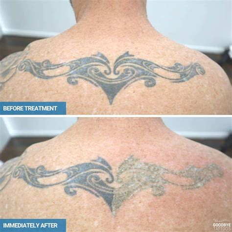 Laser Tattoo Removal Oahu at Carla Apgar blog