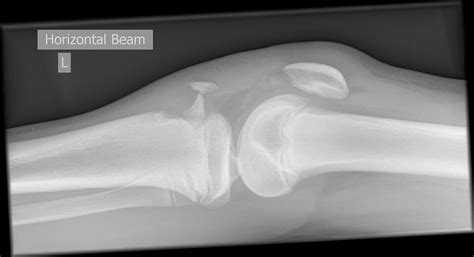 Tibial Tuberosity Brace at Carmen Decker blog