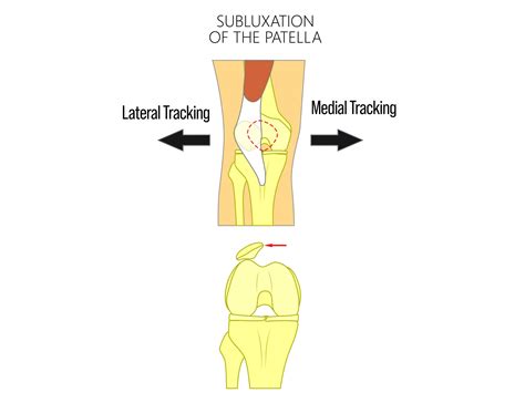 What Is Patellar Subluxation? – Brace Direct