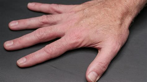Dawson's Fingers and Multiple Sclerosis: Understanding the Connection ...