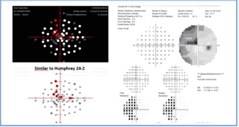 Image result for Visual Fielda Test