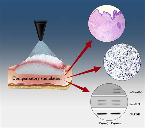 Could −79 °C Spray-Type Cryotherapy Be an Effective Monotherapy for the ...