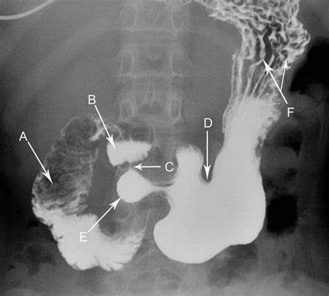 Anteroposterior radiograph of a barium examination of the stomach | The BMJ