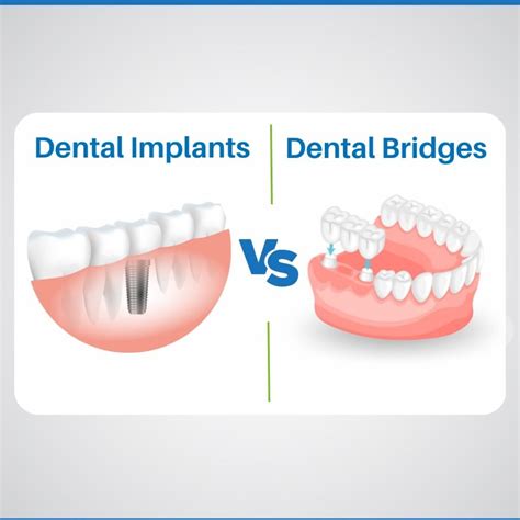Dental Implant Vs. Bridge: Pros, Cons, which is better