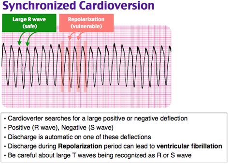 Image result for What Does Synchronized Cardioversion Do