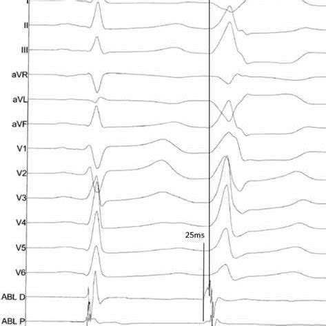 Image result for PVC Localization Chart