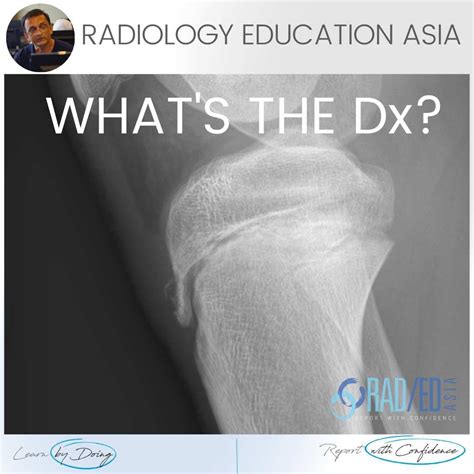 OSGOOD SCHLATTER RADIOLOGY X-RAY (VIDEO) - Radedasia