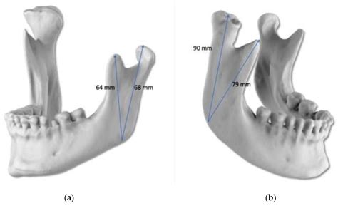 Minimally Invasive Protocol for the Management of Unilateral Condylar ...