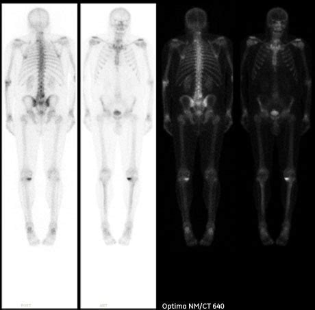Clinical Image Library - Optima NM/CT 640 - GENERAL PURPOSE HYBRID ...