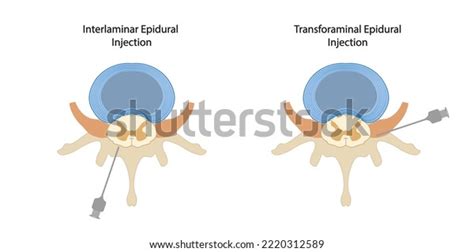 Image result for Epidural Injection