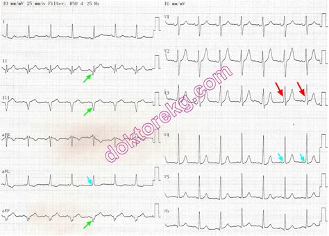eski inferoposteriyor miyokard infarktüsünü simüle eden wolff-parkinson ...
