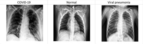 Diagnosis of COVID-19 Using Chest X-ray Images and Disease Symptoms ...