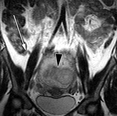MRI for Clinically Suspected Appendicitis During Pregnancy | AJR