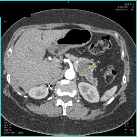 Carcinoma Tail of Pancreas with Dilated Pancreatic Duct - Pancreas ...