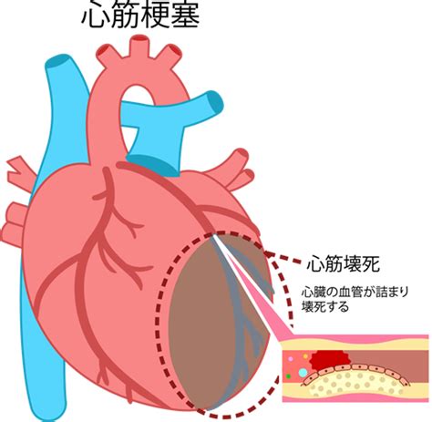 関連する画像の詳細をご覧ください。胸の痛みは何科を受診？狭心症・心筋梗塞の可能性と判断の目安