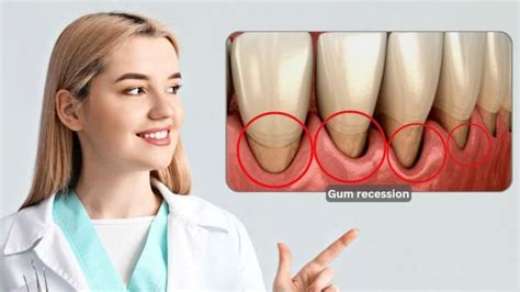 Recession Teeth 的图像结果