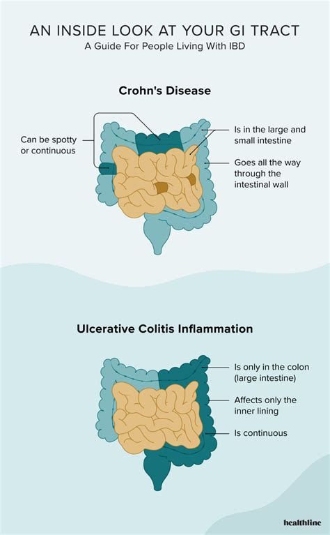Image result for How to Use IBD