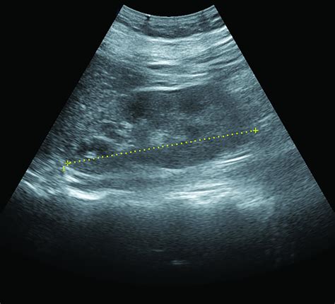 Parenchymal Renal Disease Basicmedical Key Renal And Urologic Care