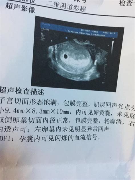 双胞胎孕囊_意外中了双胞胎，42天的B超图，有会看孕囊形状的_宝宝树