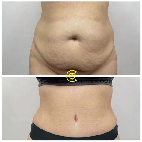 Abdominal Etching & 360 Liposuction : Cost Comparison Worldwide