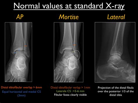 Xray Ankle