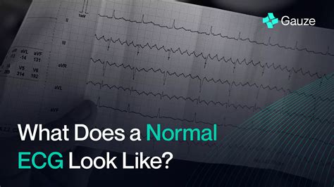 What Does a Normal ECG Look Like?