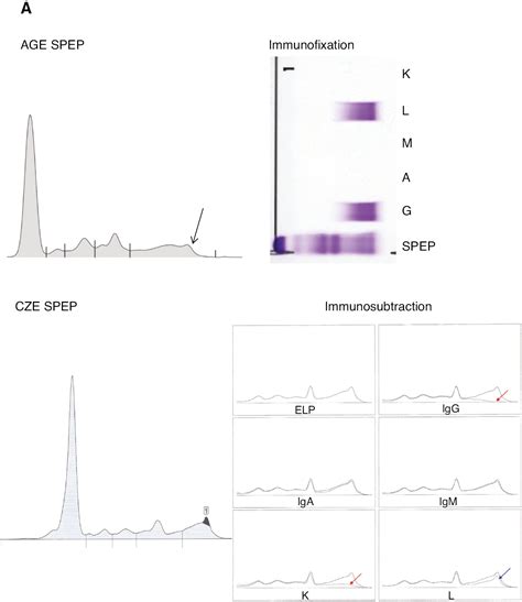 Electrophoresis Multiple Myeloma