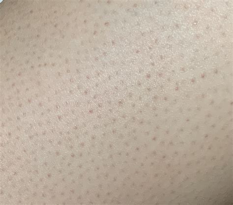 Strawberry legs advice? : r/SkincareAddicts