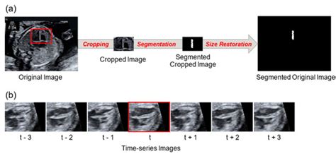 Image Segmentation of the Ventricular Septum in Fetal Cardiac ...
