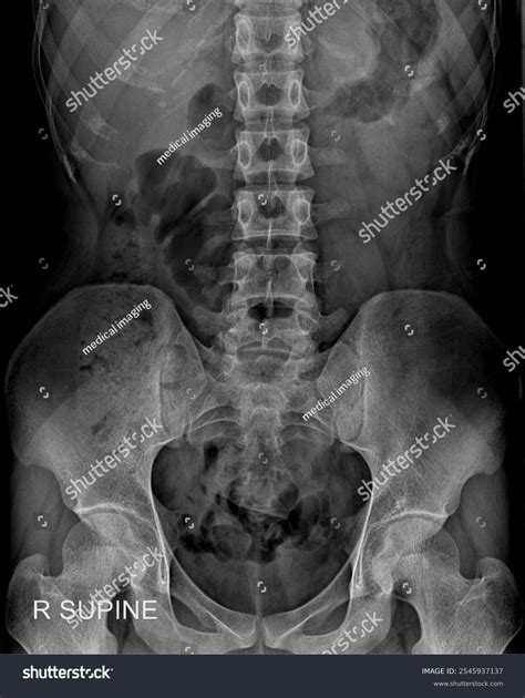 Radiographic Healthcare Imaging Kub X-ray Renal Stock Photo 2545937137 ...