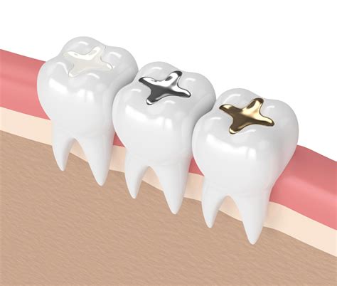 Dental Fillings: Materials and Types in Massachusetts
