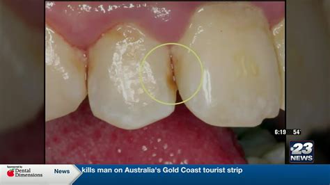 Mild Tooth Cavity